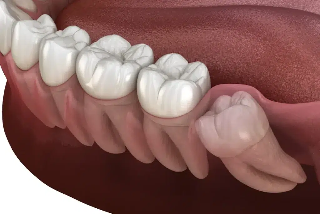 Durere extracție măsea de minte, Smile City - Clinică Stomatologică Ghencea, Sectorul 6
