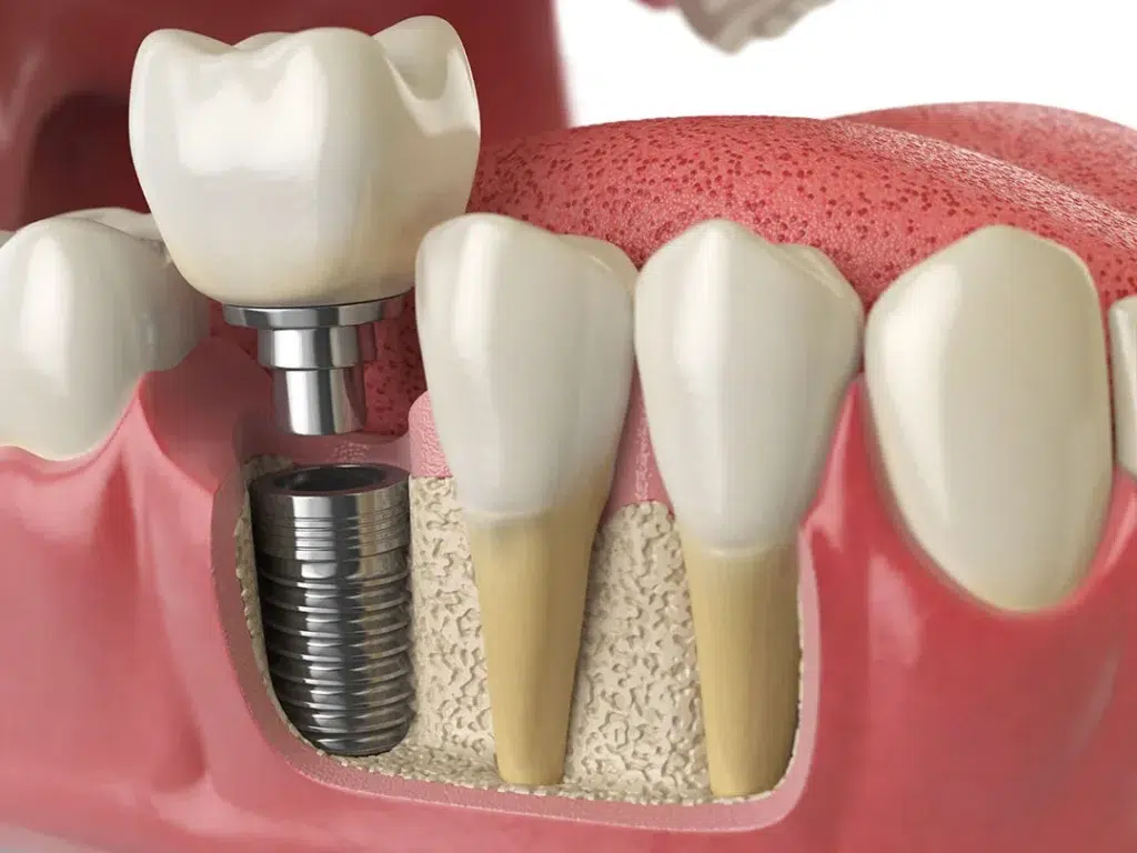 Implant Dentar Straumann in Ghencea