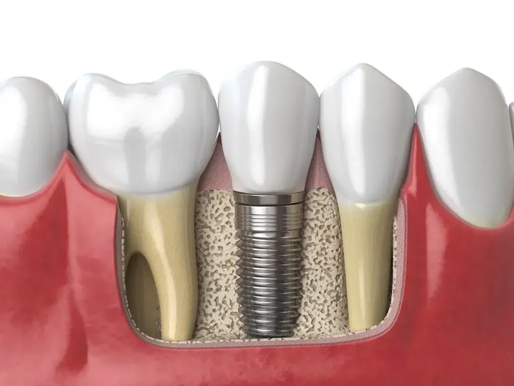 Implant Dentar Neodent