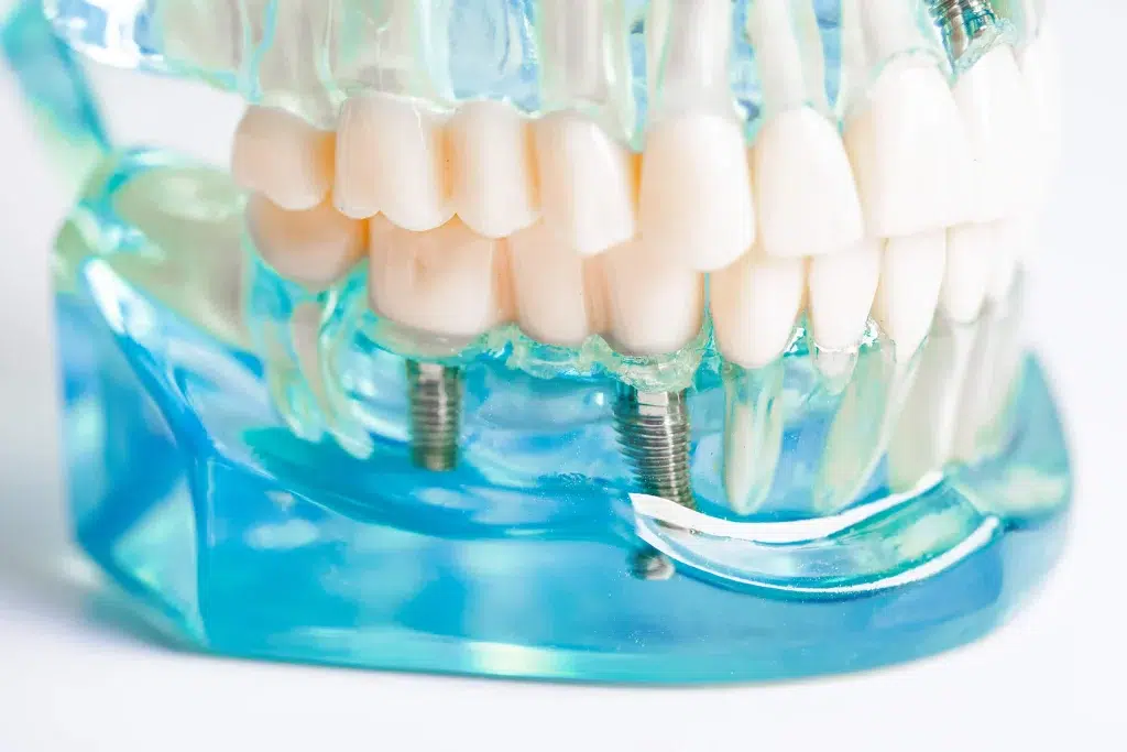 Poza cu un implant dentar aplicat in sector 6 ghencea bucuresti