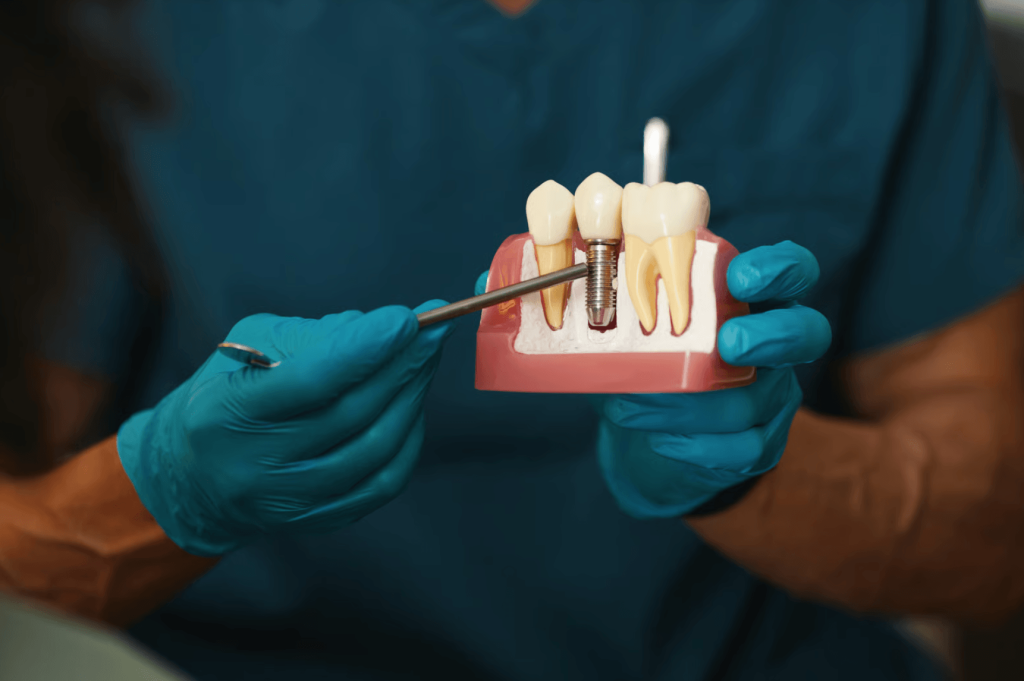 implant dentar